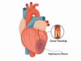 Damar Tıkanıklığına Etkili Çözüm: Koroner Bypass Ameliyatı