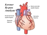 Damar Tıkanıklığına Etkili Çözüm: Koroner Bypass Ameliyatı