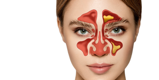 Sinüzit Nedir? Sinüzit Nedir?